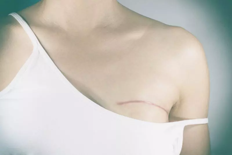 Phẫu thuật loại bỏ ung thư vú là phương pháp điều trị phổ biến.webp